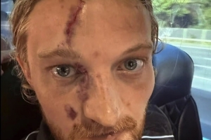 太拼了！英格兰第五级别联赛前锋与门将拼抢，面部被严重划伤